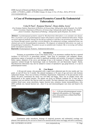 IOSR Journal of Dental and Medical Sciences (IOSR-JDMS)
e-ISSN: 2279-0853, p-ISSN: 2279-0861.Volume 14, Issue 11 Ver. IV (Nov. 2015), PP 91-94
www.iosrjournals.org
DOI: 10.9790/0853-141149194 www.iosrjournals.org 91 | Page
A Case of Postmenopausal Pyometra Caused By Endometrial
Tuberculosis
Usha R Patel1
, Ranjana Sharma2
, Deep shikha Arora3
1Post Graduate Student, Department of Obstetrics & Gynaecology, Indraprastha Apollo Hospitals, New Delhi.
2 Senior Consultant, Department of Obstetrics & Gynaecology, Indraprastha Apollo Hospitals, New Delhi.
3 Senior Consultant , Department of Pathology , Indraprastha Apollo Hospitals, New Delhi.
Abstract: A postmenopausal pyometra caused by Mycobacterium tuberculosis is an extremely rare disease.
Here, we present a case of a postmenopausal woman with pyometra caused by endometrial tuberculosis. Patient
was given empirical antibiotic therapy but she did not respond to it and there was persistence of symptoms. Pus
was drained through stenotic canal after cervical dilatation. On endometrial curettage, endometrial tissue was
obtained and sent for histopathological examination. The diagnosis of endometrial tuberculosis was made on
histopathological examination. The patient was put on antitubercular treatment. She is recovering well without
further development of pyometra .
Keywords: Postmenopausal; Pyometra ; Endometrial tuberculosis
I. Introduction:
Pyometra, an accumulation of pus in the uterine cavity, is an uncommon condition that has a reported
incidence of 0.01%-0.5% in gynecologic patients1
. Apart from its association with malignant disease,
spontaneous rupture of pyometra can result in significant morbidity and mortality. If pyometra is diagnosed
before rupture, dilatation of the cervix and drainage of pus is the treatment of choice. The most common
organisms isolated through the bacteriologic study are Escherichia coli and Bacteroides fragilis2
. Rarely,
Mycobacterium tuberculosis may also be isolated in women of reproductive age group however, it is rare in
postmenopausal women.
II. Case Report
A 68-year-old woman, who presented with a vague lower abdominal pain for nine months and low
grade, on and off fever for 8 months. She attained menopause at 50 years of age and never took hormone
replacement therapy. There was no history of Diabetes, Hypertension, Tuberculosis in the past and also in her
family. On pelvic examination the uterus was soft bulky and boggy. There was an atrophic lesion with
desquamation at the vaginal introitus. The patient was given an antibiotic treatment for 14 days but her
symptoms were not relieved. Her Pap test result was normal. The basic laboratory tests screening, including a
complete blood count, serum electrolytes, hepatic function tests, urinalysis, human immunodeficiency virus
(HIV) antibody test, thyroid function test , chest X ray and electrocardiogram were done and found to be
normal.
Examination under anaesthesia, drainage of suspected pyometra and endometrial curettage was
planned. Intra-operatively the cervical os found to be stenosed and the uterus was boggy and soft in consistency.
Fig. 1. A 68-year-old postmenopausal woman
diagnosed with pyometra, (A) Transvaginal
pelvic ultrasound shows a dilated fluid filled
endometrial cavity.
 