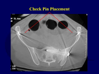 V02 pelvis acute_mgmt | PPT