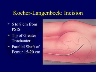 Kocher-Langenbeck: Incision
• 6 to 8 cm from
PSIS
• Tip of Greater
Trochanter
• Parallel Shaft of
Femur 15-20 cm
 