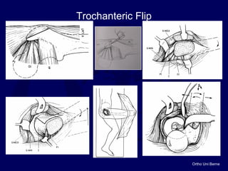 Ortho Uni Berne
Trochanteric Flip
 