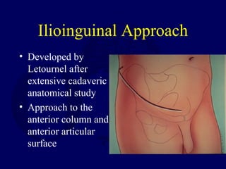 Ilioinguinal Approach
• Developed by
Letournel after
extensive cadaveric
anatomical study
• Approach to the
anterior column and
anterior articular
surface
 