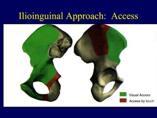 Ilioinguinal Approach: Access
 