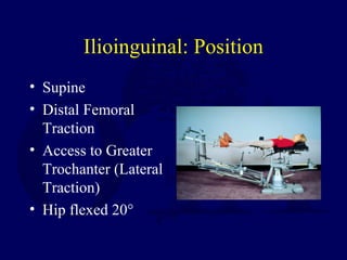 Ilioinguinal: Position
• Supine
• Distal Femoral
Traction
• Access to Greater
Trochanter (Lateral
Traction)
• Hip flexed 20°
 