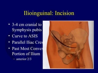 Ilioinguinal: Incision
• 3-4 cm cranial to
Symphysis pubis
• Curve to ASIS
• Parallel Iliac Crest
• Past Most Convex
Portion of Ilium
– anterior 2/3
 