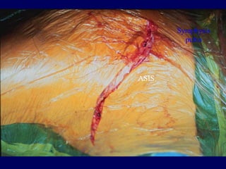Symphysis
pubis
ASIS
 