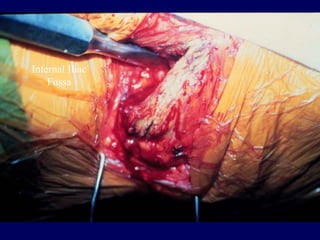 Internal Iliac
Fossa
 