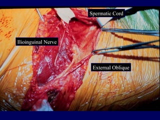 External Oblique
Ilioinguinal Nerve
Spermatic Cord
 