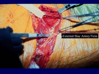 External Iliac Artery/Vein
 