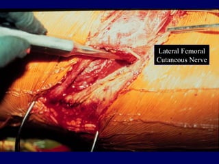 Lateral Femoral
Cutaneous Nerve
 