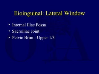 Ilioinguinal: Lateral Window
• Internal Iliac Fossa
• Sacroiliac Joint
• Pelvic Brim - Upper 1/3
 