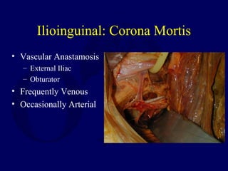 Ilioinguinal: Corona Mortis
• Vascular Anastamosis
– External Iliac
– Obturator
• Frequently Venous
• Occasionally Arterial
 