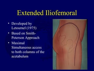 Extended Iliofemoral
• Developed by
Letournel (1975)
• Based on Smith-
Peterson Approach
• Maximal
Simultaneous access
to both columns of the
acetabulum
 