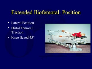 Extended Iliofemoral: Position
• Lateral Position
• Distal Femoral
Traction
• Knee flexed 45°
 