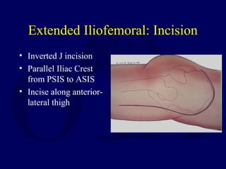 Extended Iliofemoral: Incision
• Inverted J incision
• Parallel Iliac Crest
from PSIS to ASIS
• Incise along anterior-
lateral thigh
 