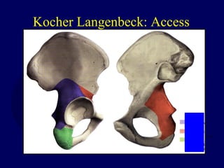 Kocher Langenbeck: Access
 