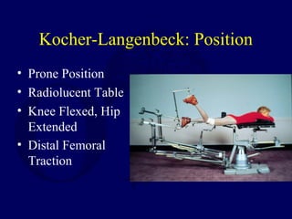 Kocher-Langenbeck: Position
• Prone Position
• Radiolucent Table
• Knee Flexed, Hip
Extended
• Distal Femoral
Traction
 
