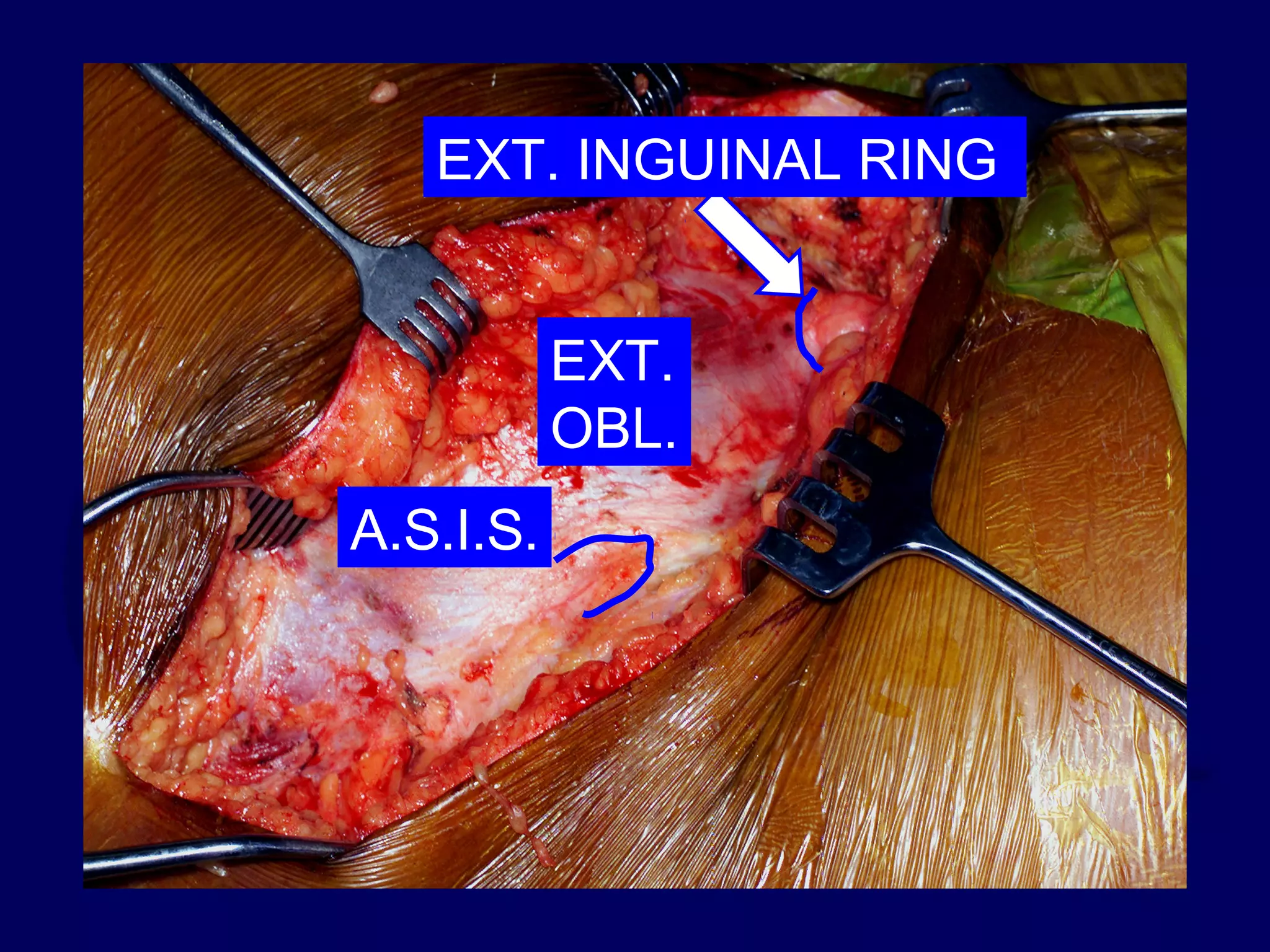 EXT.
OBL.
A.S.I.S.
EXT. INGUINAL RING
 