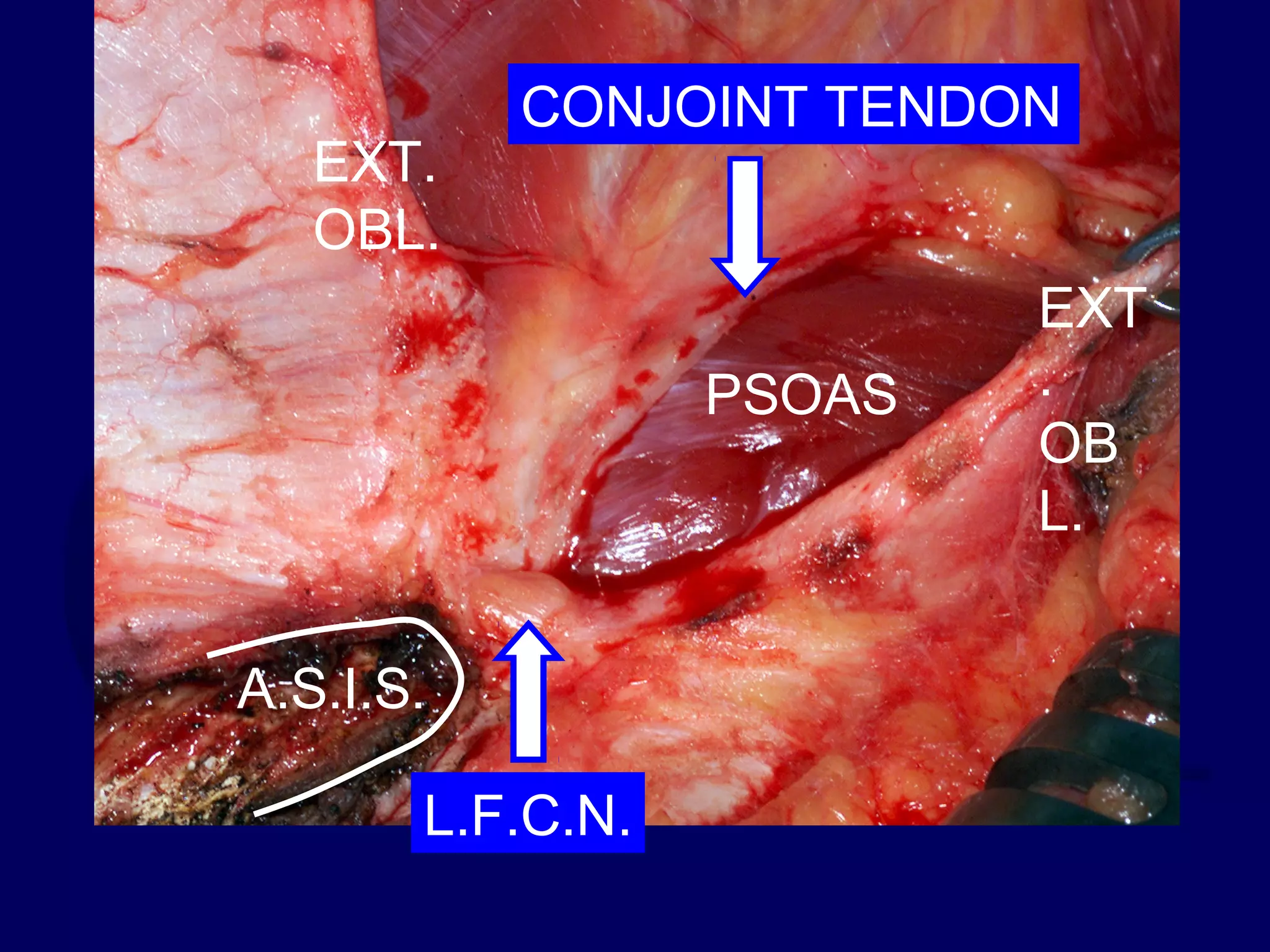 A.S.I.S.
L.F.C.N.
PSOAS
EXT
.
OB
L.
EXT.
OBL.
CONJOINT TENDON
 