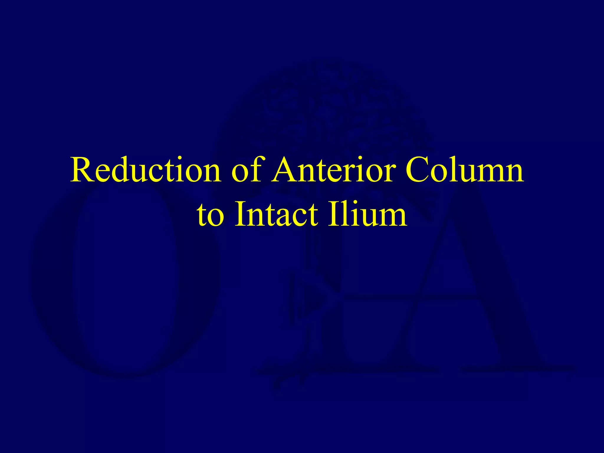 Reduction of Anterior Column
to Intact Ilium
 