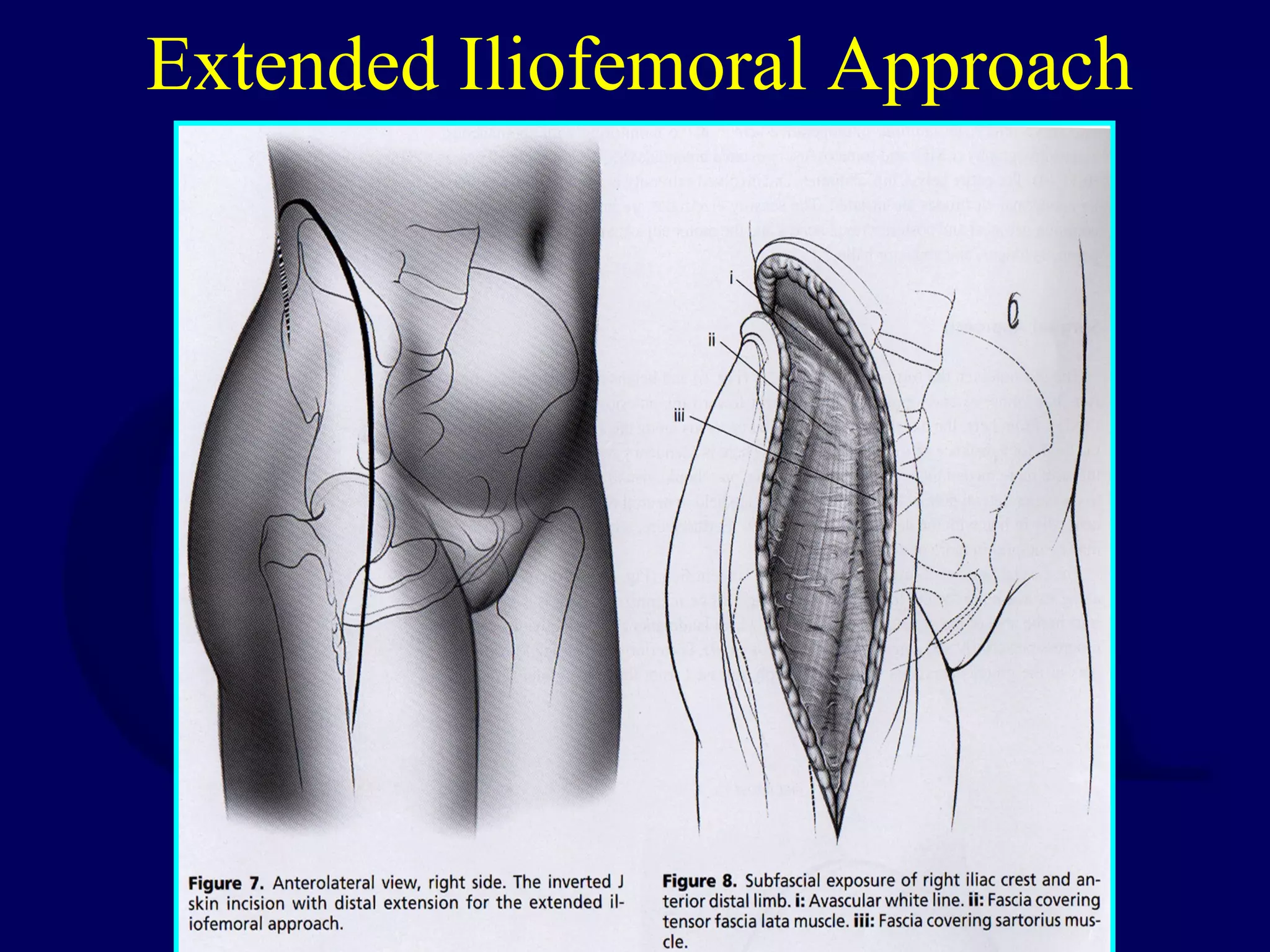 Extended Iliofemoral Approach
 