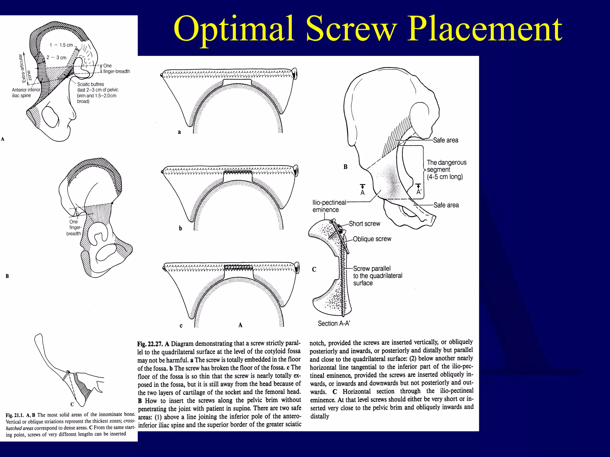 Letournel 1993
Optimal Screw Placement
 