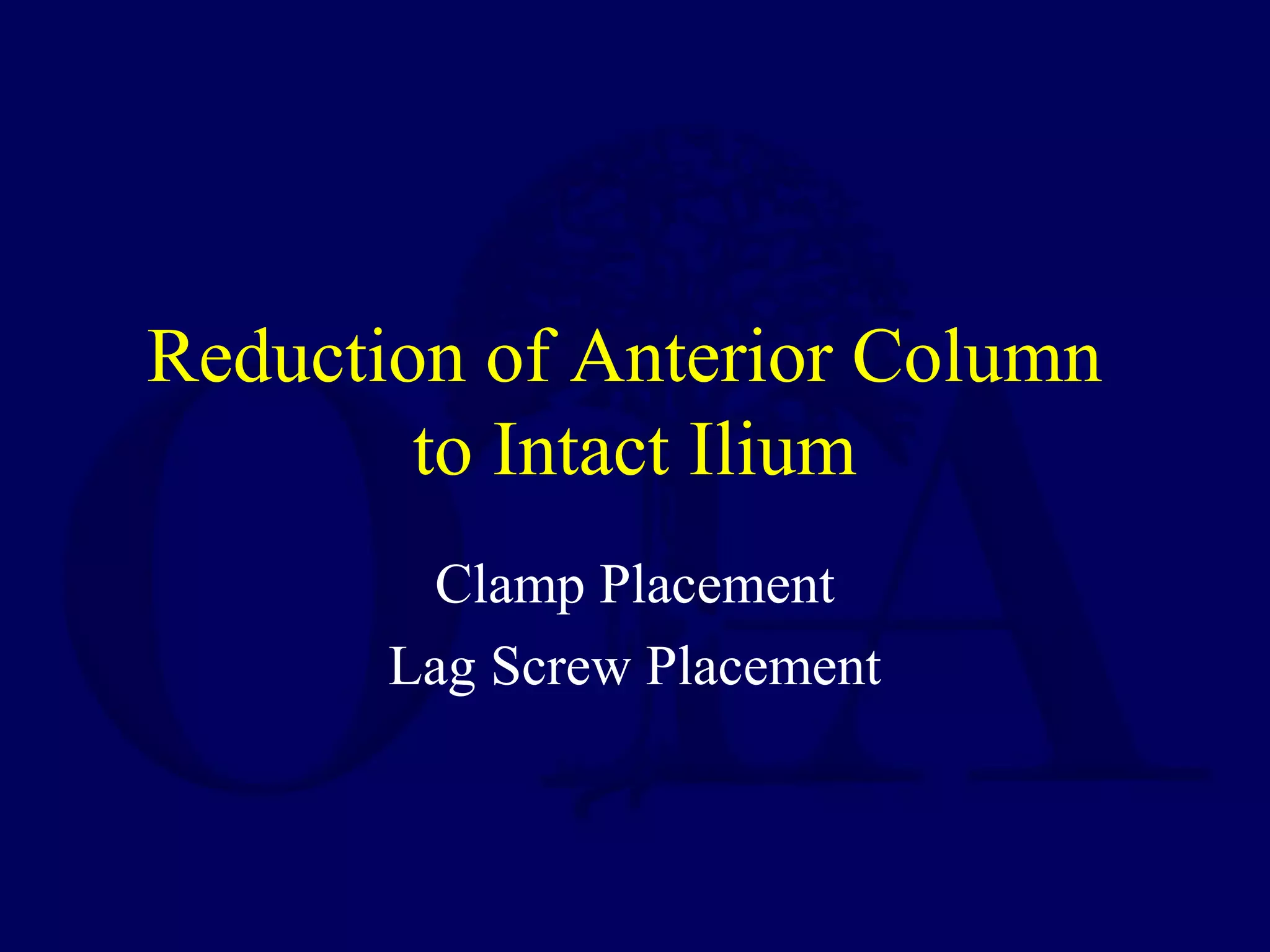 Reduction of Anterior Column
to Intact Ilium
Clamp Placement
Lag Screw Placement
 