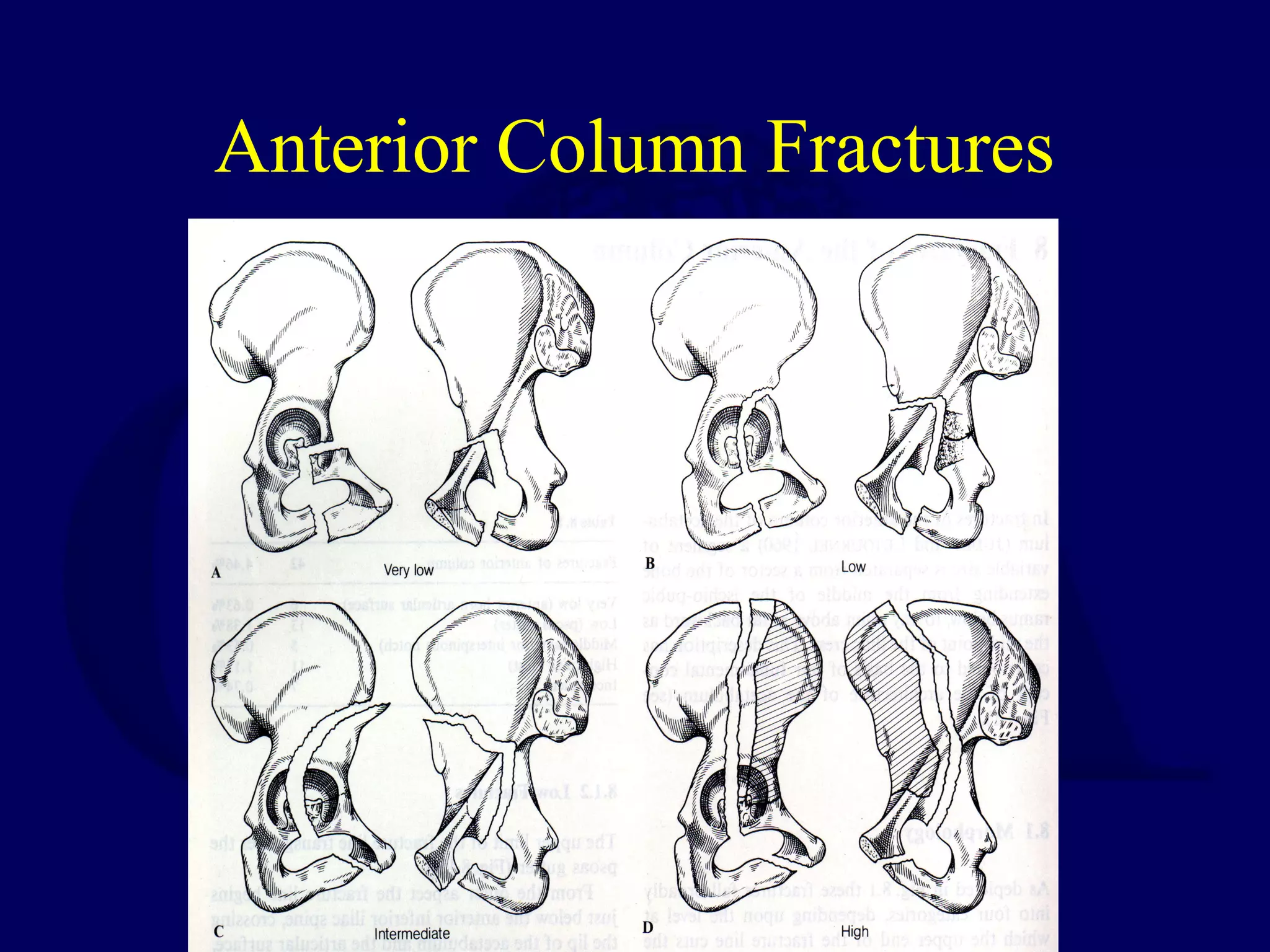 Anterior Column Fractures
 