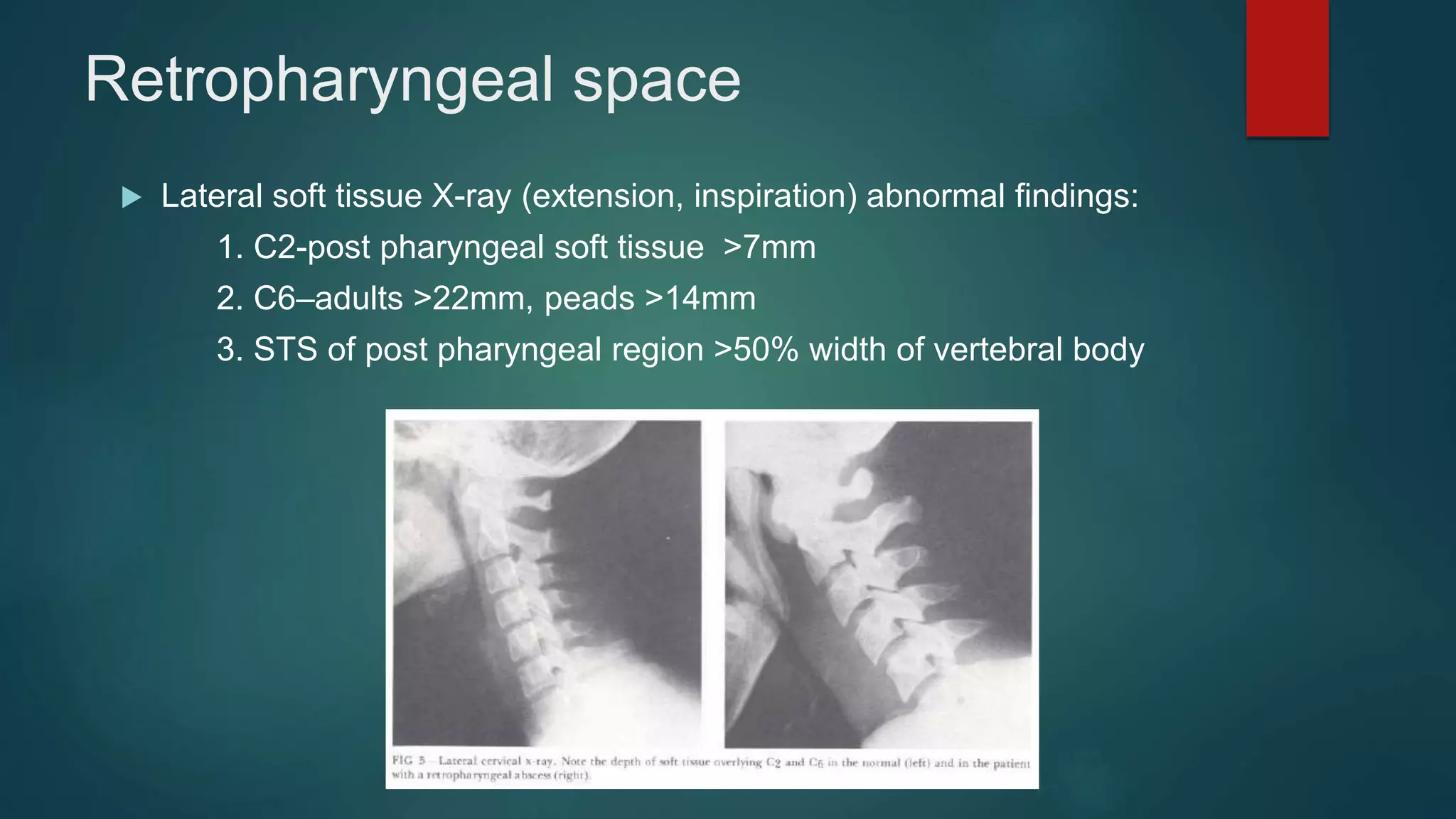 Retropharyngeal space
 Lateral soft tissue X-ray (extension, inspiration) abnormal findings:
1. C2-post pharyngeal soft tissue >7mm
2. C6–adults >22mm, peads >14mm
3. STS of post pharyngeal region >50% width of vertebral body
 