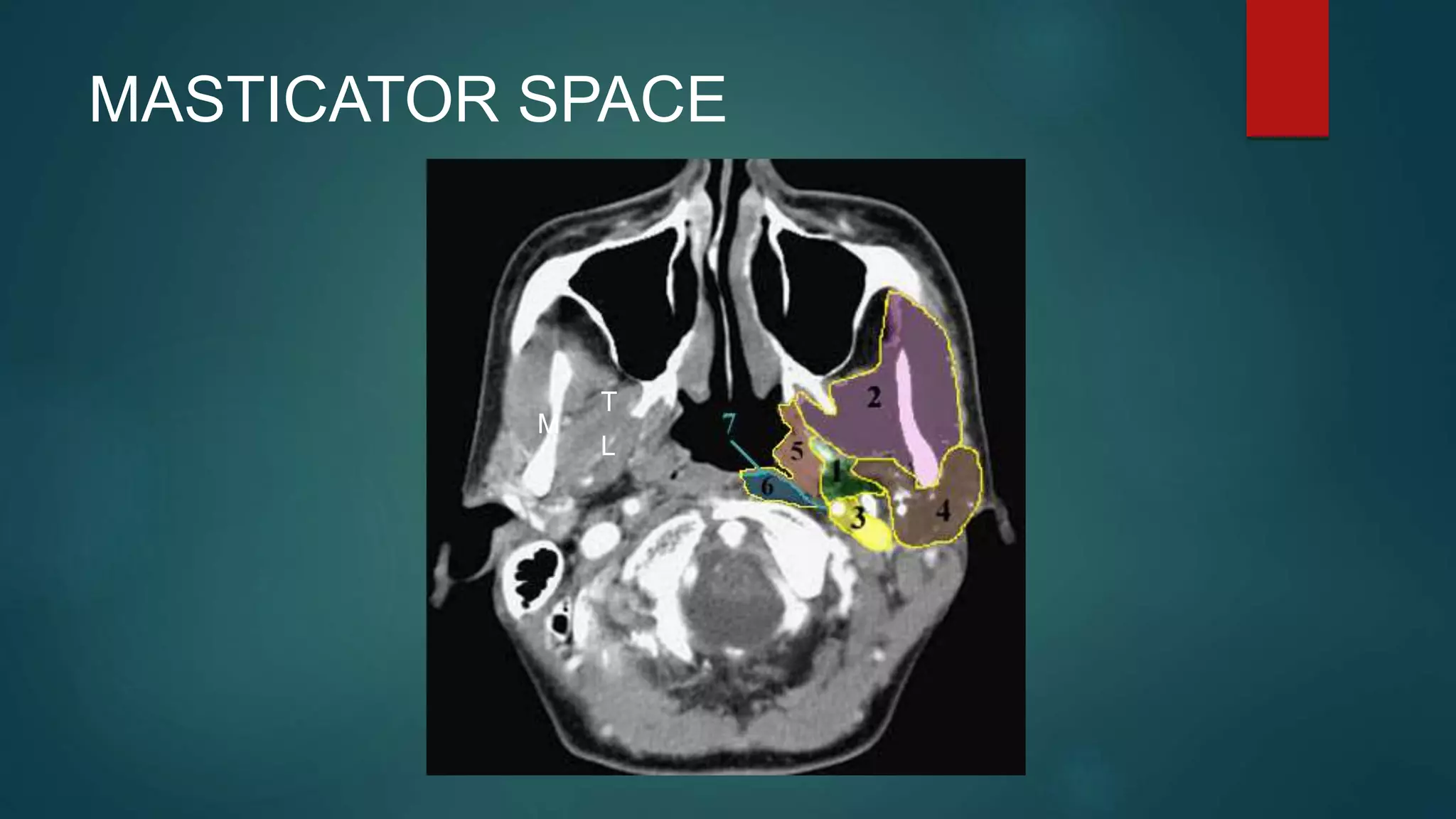 MASTICATOR SPACE
M
T
L
 