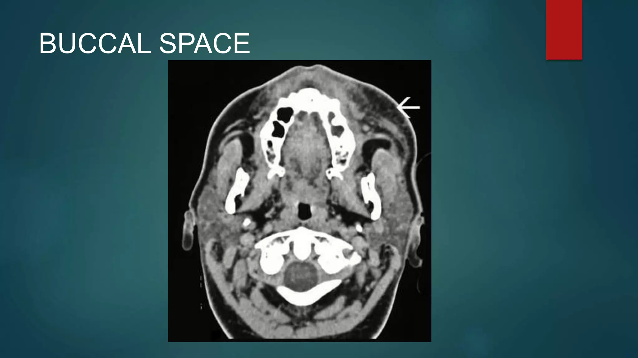 BUCCAL SPACE
 