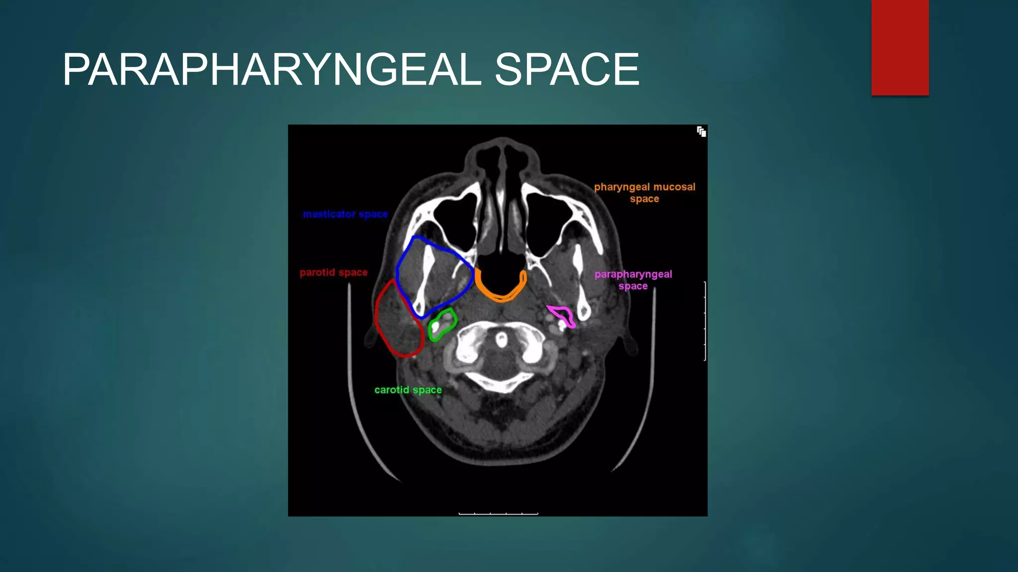 PARAPHARYNGEAL SPACE
 