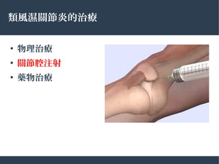 類風濕關節炎的治療
●
物理治療
●
關節腔注射
●
藥物治療
 