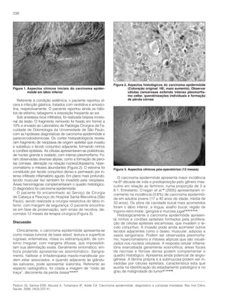 238




                                                                      Figura 2. Aspectos histológicos do carcinoma epidermóide
Figura 1. Aspectos clínicos iniciais do carcinoma epider-                       (Coloração original: HE; maio aumento). Observar
          móide em lábio inferior                                               células cancerosas exibindo intenso pleomorfis-
                                                                                mo cellar, queratinizações individuais e formação
   Referente à condição sistêmica, o paciente reportou úl-                      de pérola córnea
cera e infecção gástrica, tratados com ranitidina e amoxici-
lina, respectivamente. O paciente reportou ainda os hábi-
tos de etilismo, tabagismo e exposição freqüente ao sol.
   Sob anestesia local infiltrativa, foi realizada biópsia incisio-
nal da lesão. O fragmento removido foi fixado em formol a
10% e enviado ao Laboratório de Patologia Cirúrgica da Fa-
culdade de Odontologia da Universidade de São Paulo,
com as hipóteses diagnósticas de carcinoma epidermóide e
paracoccidioidomicose. Os cortes histopatológicos revela-
ram fragmento de neoplasia de origem epitelial que invadiu
e substituiu o tecido conjuntivo adjacente, formando ninhos
e cordões epiteliais. As células apresentaram-se poliédricas,
de núcleo grande e ovalado, com intenso pleomorfismo. Fo-
ram observadas diversas atipias, como a formação de péro-
las córneas, alteração na relação núcleo/citoplasma, hiper-
                                                                      Figura 3. Aspectos clínicos pós-operatórios (12 meses)
cromatismo e mitoses abundantes (Figura 2). O estroma foi
constituído por tecido conjuntivo denso e permeado por in-
tenso infiltrado inflamatório agudo. Em plano mais profundo,             O carcinoma epidermóide apresenta maior incidência
tecido muscular liso também foi invadido pela neoplasia.              na 6ª década de vida e predisposição pelo gênero mas-
Áreas hemorrágicas complementaram o quadro histológico.               culino em relação ao feminino, numa proporção de 2 a
O diagnóstico foi carcinoma epidermóide.                              8:1. Entretanto, O’regan et al.18 (2005) apresentaram in-
   O paciente foi encaminhado ao Serviço de Cirurgia                  cremento na incidência (4,6%) de carcinoma epidermói-
de Cabeça e Pescoço do Hospital Santa Marcelina (São                  de em adultos jovens (17 a 40 anos de idade; média de
Paulo), sendo realizada a cirurgia ressectiva do lábio in-            33 anos). Os sítios da cavidade bucal mais acometidos
ferior, com margem de segurança. O paciente encontra-                 foram o lábio inferior, a língua, soalho bucal, região de
se em fase de proservação, sem sinais de recidiva, de-                trigono-retro-molar, gengiva e mucosa jugal7,9-10,12-13,19.
corridos 12 meses da terapia cirúrgica (Figura 3).                       Histologicamente o carcinoma epidermóide apresen-
Discussão
                                                                      ta ninhos e cordões epiteliais formados pela prolifera-
                                                                      ção de células epiteliais escamosas, que invadem o te-
                                                                      cido conjuntivo. A invasão pode ainda acometer outros
   Clinicamente, o carcinoma epidermóide apresenta-se                 tecidos adjacentes como o ósseo, muscular, adiposo e
como massa tumoral de base séssil; textura e superfície               vasos sangüíneos. Podem ser observados pleomorfis-
rugosas; eritematosa, rósea ou esbranquiçado; de con-                 mo, hipercromatismo e mitoses atípicas que são visuali-
torno irregular; com margens difusas, que impossibili-                zados nos núcleos celulares. A resposta celular inflama-
tam sua delimitação exata. Geralmente sintomático, em-                tória exarcebada geralmente eosinofílica, áreas focais
bora podendo apresentar-se assintomático. Sangra-                     de necrose e fibrose densa podem complementar o
mento, halitose e linfadenopatia maxilo-mandibular po-                quadro histológico. Apresenta ainda potencial de angio-
dem estar associados, e quando adjacente às glându-                   gênese. A lâmina própria e a submucosa podem ser in-
las salivares, pode apresentar sialorréia. Referente ao               vadidas por células epiteliais, característica esta que
aspecto radiográfico, foi citada a imagem de “roído de                auxilia na identificação do estadiamento patológico e no
traça”, decorrente da perda óssea1,5,9,16-17.                         grau de malignidade do tumor3,7,14,18-20.


Pedron IG, Santos ESR, Aburad A, Tortamano IP, Adde CA. Carcinoma epidermóide: diagnóstico e condutas imediatas. Rev Inst Ciênc
Saúde. 2006; 24(3):237-41.
 