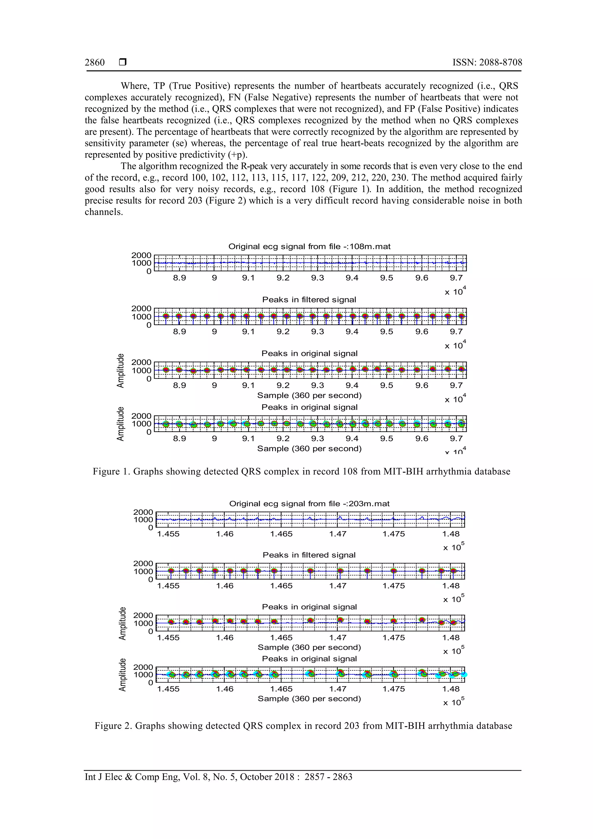  ISSN: 2088-8708
Int J Elec & Comp Eng, Vol. 8, No. 5, October 2018 : 2857 - 2863
2860
Where, TP (True Positive) represents the number of heartbeats accurately recognized (i.e., QRS
complexes accurately recognized), FN (False Negative) represents the number of heartbeats that were not
recognized by the method (i.e., QRS complexes that were not recognized), and FP (False Positive) indicates
the false heartbeats recognized (i.e., QRS complexes recognized by the method when no QRS complexes
are present). The percentage of heartbeats that were correctly recognized by the algorithm are represented by
sensitivity parameter (se) whereas, the percentage of real true heart-beats recognized by the algorithm are
represented by positive predictivity (+p).
The algorithm recognized the R-peak very accurately in some records that is even very close to the end
of the record, e.g., record 100, 102, 112, 113, 115, 117, 122, 209, 212, 220, 230. The method acquired fairly
good results also for very noisy records, e.g., record 108 (Figure 1). In addition, the method recognized
precise results for record 203 (Figure 2) which is a very difficult record having considerable noise in both
channels.
Figure 1. Graphs showing detected QRS complex in record 108 from MIT-BIH arrhythmia database
Figure 2. Graphs showing detected QRS complex in record 203 from MIT-BIH arrhythmia database
8.9 9 9.1 9.2 9.3 9.4 9.5 9.6 9.7
x 10
4
0
1000
2000
Original ecg signal from file -:108m.mat
8.9 9 9.1 9.2 9.3 9.4 9.5 9.6 9.7
x 10
4
0
1000
2000
Peaks in filtered signal
8.9 9 9.1 9.2 9.3 9.4 9.5 9.6 9.7
x 10
4
0
1000
2000
Peaks in original signal
Sample (360 per second)
Amplitude
8.9 9 9.1 9.2 9.3 9.4 9.5 9.6 9.7
x 10
4
0
1000
2000
Peaks in original signal
Sample (360 per second)
Amplitude
1.455 1.46 1.465 1.47 1.475 1.48
x 10
5
0
1000
2000
Original ecg signal from file -:203m.mat
1.455 1.46 1.465 1.47 1.475 1.48
x 10
5
0
1000
2000
Peaks in filtered signal
1.455 1.46 1.465 1.47 1.475 1.48
x 10
5
0
1000
2000
Peaks in original signal
Sample (360 per second)
Amplitude
1.455 1.46 1.465 1.47 1.475 1.48
x 10
5
0
1000
2000
Peaks in original signal
Sample (360 per second)
Amplitude
 