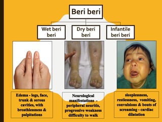 Beri beri
Wet beri
beri
Dry beri
beri
Infantile
beri beri
 