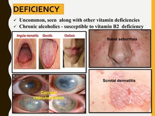 DEFICIENCY
•
 Uncommon, seen along with other vitamin deficiencies
 Chronic alcoholics - susceptible to vitamin B2 deficiency
Nasal seborrhea
Scrotal dermatitis
Corneal
vascularization
 