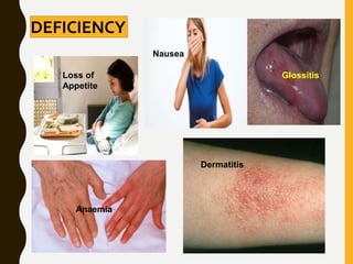 DEFICIENCY
Loss of
Appetite
Anaemia
Dermatitis
Nausea
Glossitis
 