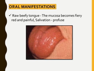 ORAL MANIFESTATIONS
 Raw beefy tongue -The mucosa becomes fiery
red and painful, Salivation - profuse
 