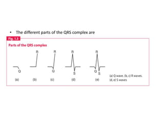 • The different parts of the QRS complex are
 