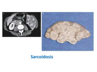 Sarcoidosis