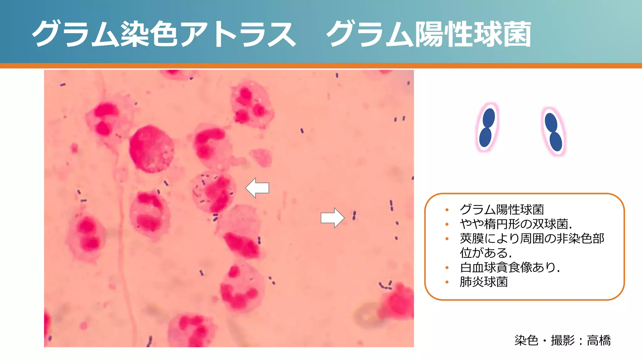 グラム染色アトラス グラム陽性球菌
染色・撮影：高橋
• グラム陽性球菌
• やや楕円形の双球菌．
• 莢膜により周囲の非染色部
位がある．
• 白血球貪食像あり．
• 肺炎球菌
 