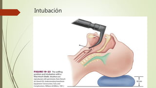 Intubación
 