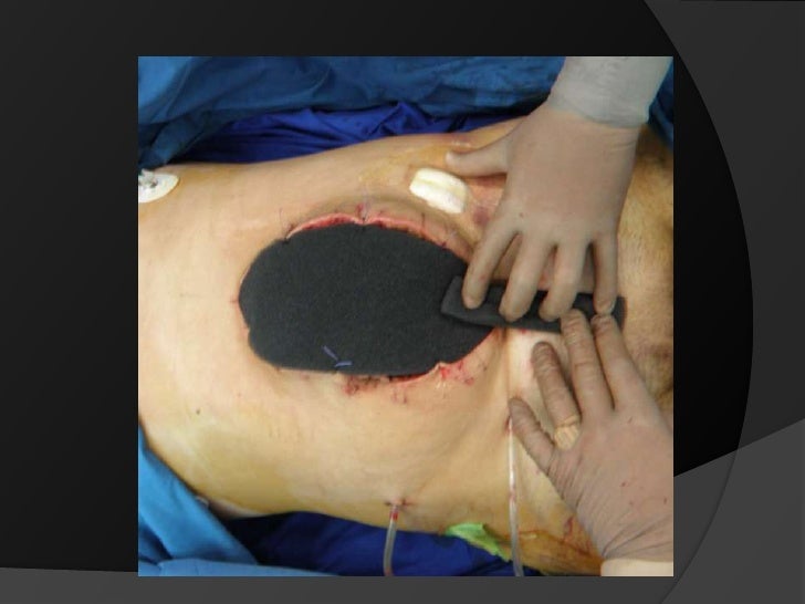 v a c therapy in bulgaria initial experience