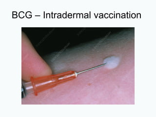 BCG – Intradermal vaccination
 