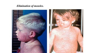 Elimination of measles.
 