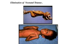 Elimination of Neonatal Tetanus .
 