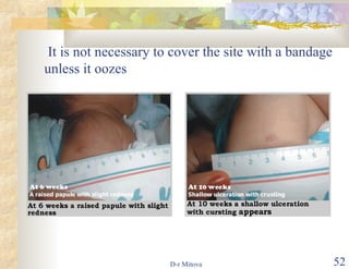 It is not necessary to cover the site with a bandage unless it oozes 