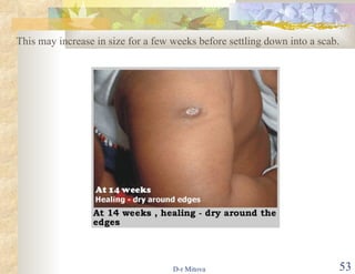 This may increase in size for a few weeks before settling down into a scab. 