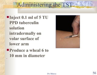 Administering the TST Inject 0.1 ml of 5 TU PPD tuberculin solution intradermally on volar surface of lower arm  Produce a wheal 6 to 10 mm in diameter 