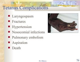 Tetanus Complications Laryngospasm Fractures Hypertension Nosocomial infections Pulmonary embolism Aspiration Death 